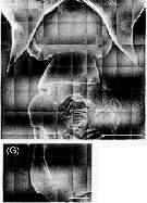 Espèce Labidocera acutifrons - Planche 17 de figures morphologiques
